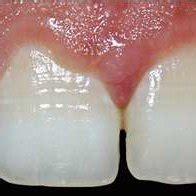 The clinical palatal view shows prominent palatal cingulum with... | Download Scientific Diagram