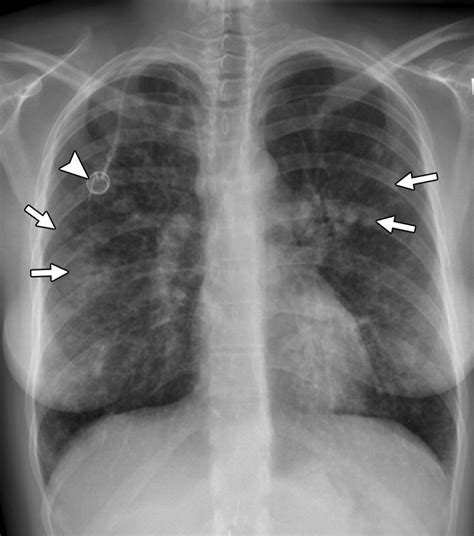 Pulmonary Fibrosis X Ray