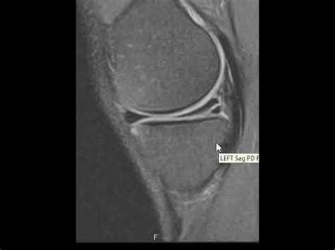 Knee MRI Scan of a Meniscus Tear | First Look MRI - YouTube