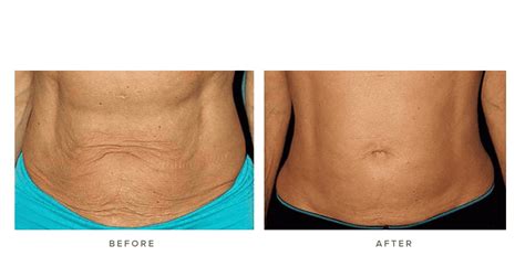 Thermage Body Before and Afters | Infinity Skin Clinic Sydney