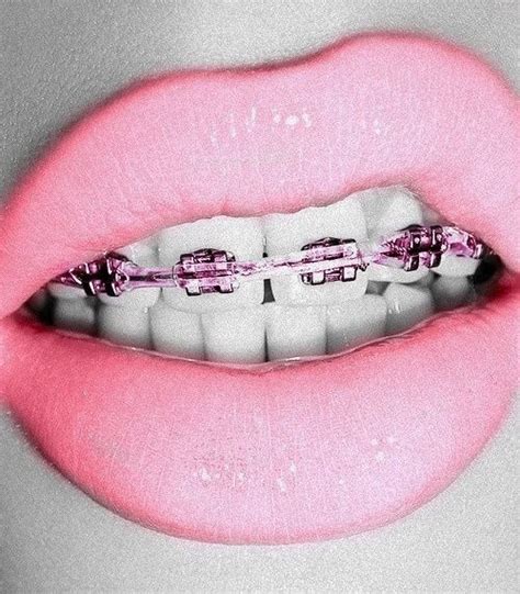 Hot Pink Braces Colors – Warehouse of Ideas