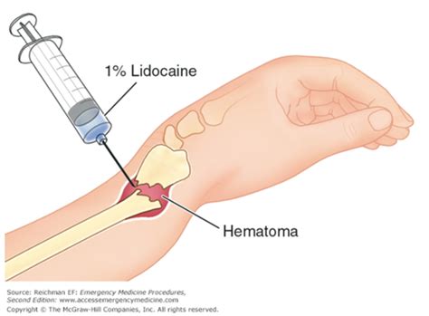 Hematoma Blocks — Kwak Talk