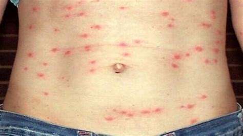 Typhus Causes, Symptoms, Diagnosis and Treatment | Natural Health News