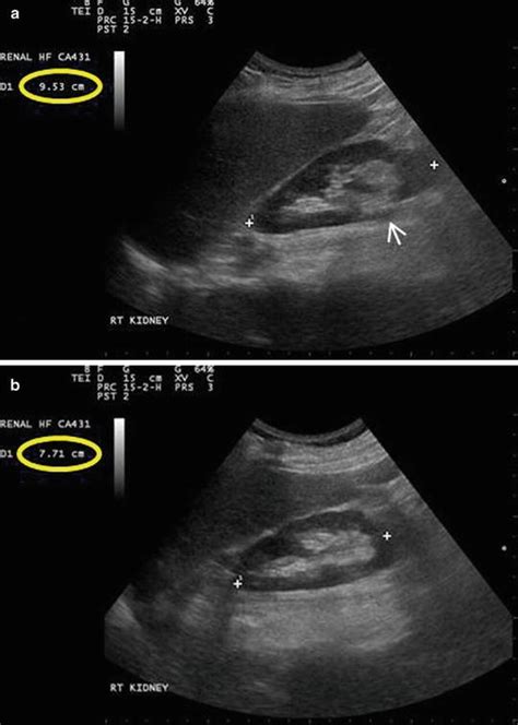 Renal Ultrasound Transverse