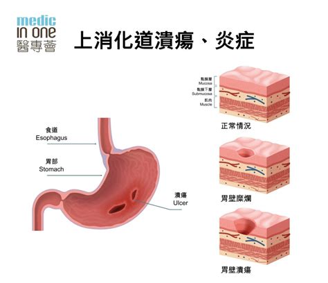 上消化道溃疡、炎症