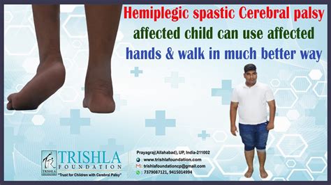 Hemiplegic spastic Cerebral palsy affected child can use affected hands ...