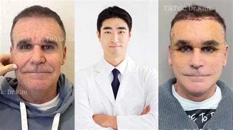 TikTok’s Elusive ‘Dr Kim’ Shares Post-Op Pics of $50,000 Facelift ...