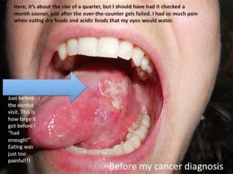 Tongue Cancer, Squamous Cell Carcinoma in Young People, Do you have it ...