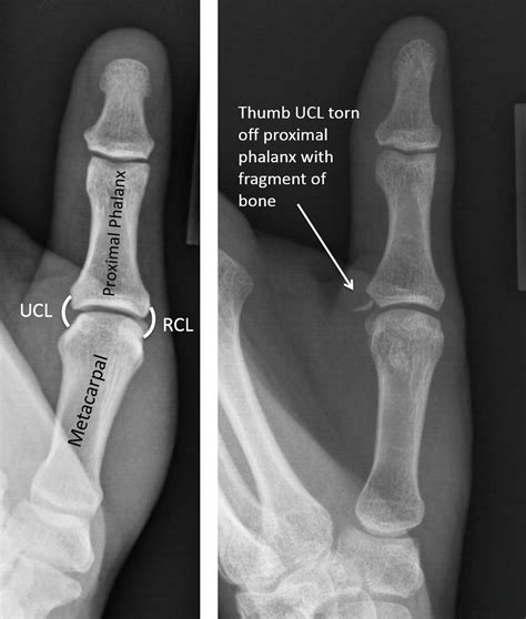 Thumb sprains — Joseph J. Schreiber, MD