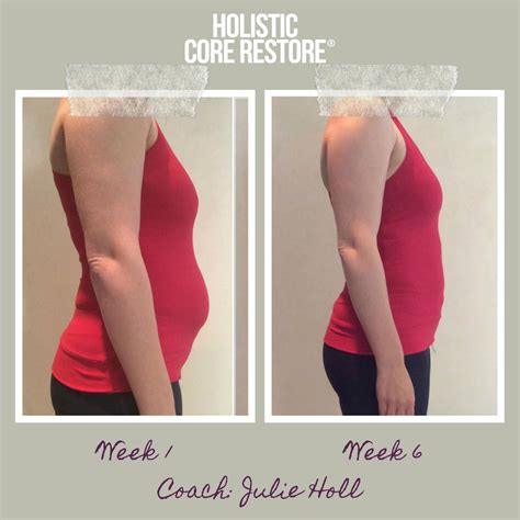 Before & After Diastasis Recti Repair Gallery - Holistic Core Restore