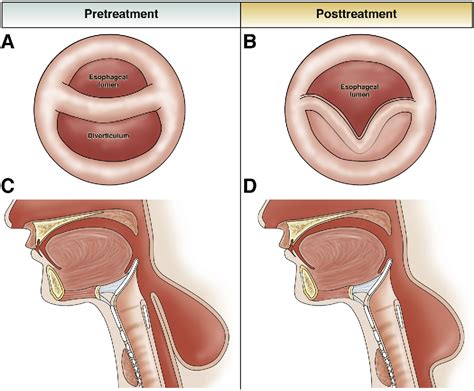 Figure 3 from Zenker's Diverticulum. | Semantic Scholar