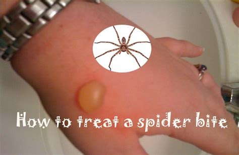 15 Home Remedies to Treat a Spider Bite Quickly at Home