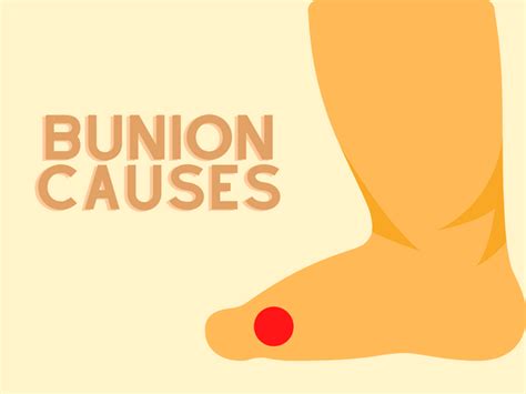 Understanding Bunion Problem - Causes & Treatments - Luxury Stnd