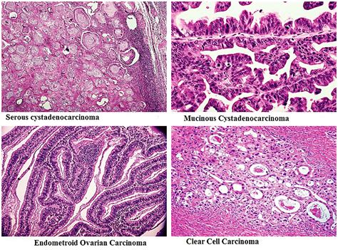 Clear Cell Ovarian Cancer - slidesharetrick