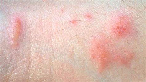 How To Get Rid Of Contact Dermatitis - Distancetraffic19