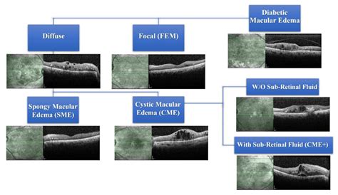 JCM | Free Full-Text | Choroidal Thickness in Different Patterns of Diabetic Macular Edema