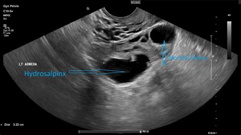 Gynaecology Ultrasound - Women's Ultrasound Melbourne