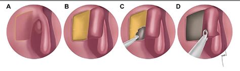 Figure 1 from The Fibrin Glue Application Enhances Surgical Success ...