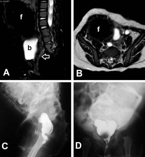 MRI of persistent cloaca: Can it substitute conventional imaging ...