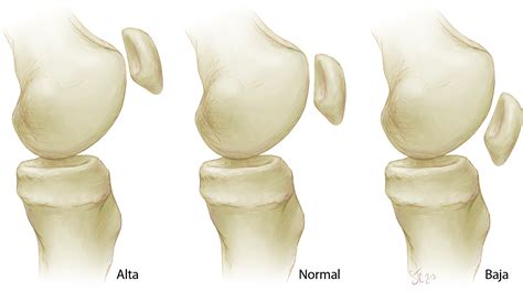 Patellofemoral Anatomy and Biomechanics - Clinics in Sports Medicine