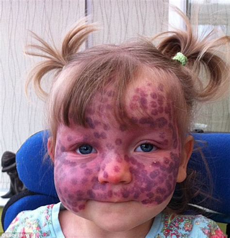 Toddler Matilda Callaghan, 2, treats severe birthmark with laser ...