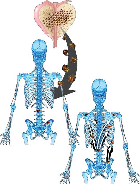 Treating Prostate Cancer & Bone Metastasis | Battle In The Bone