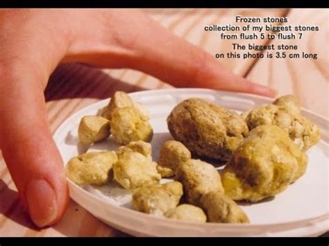 GALLSTONES, LIVER STONES | FULL HEALTH SECRETS