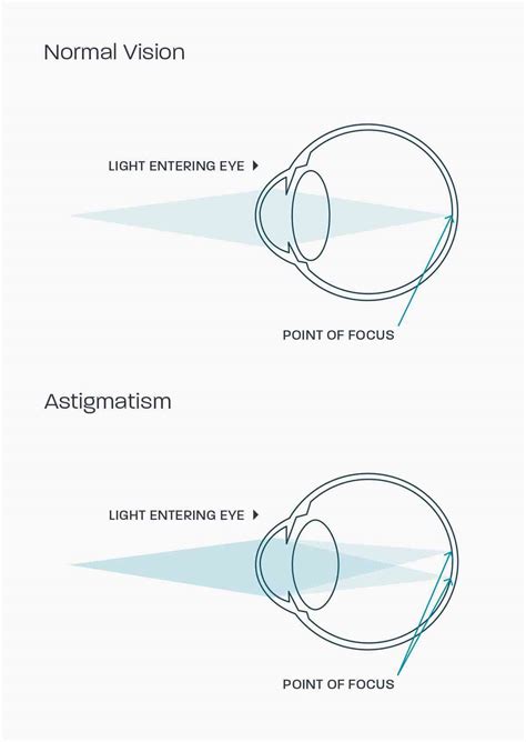 Astigmatism | Glasses Direct