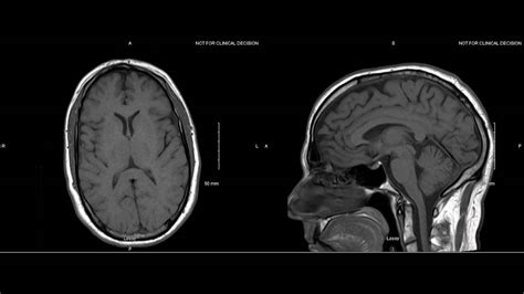 Normal Brain Mri With Contrast Images Radiologia