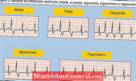 Ventricular extrasystole: causes, symptoms and treatment - medical - 2024