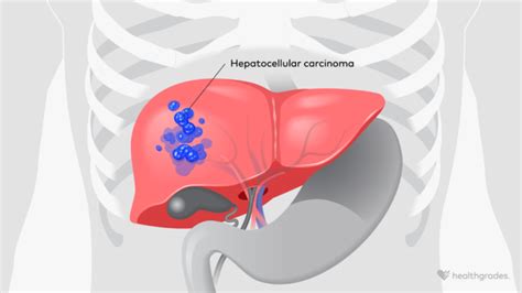 Hepatocellular Carcinoma: Symptoms, Causes, Treatments