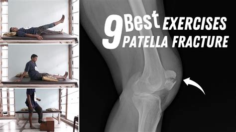 Patella Fracture Exercises