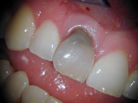 Dr JT (Koos) Marais - My Casebook - Root canal treatment tooth ache dentist pain Pretoria