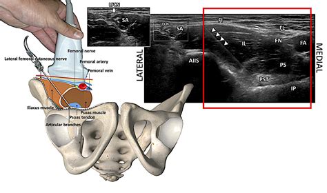 How I Do It: PEricapsular Nerve Group (PENG) Block