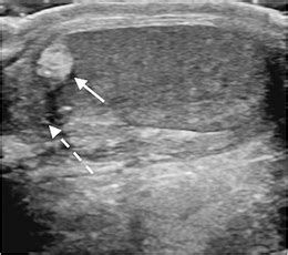 Torsion of the appendix testis in a 7-year-old boy. Sagittal gray-scale... | Download Scientific ...