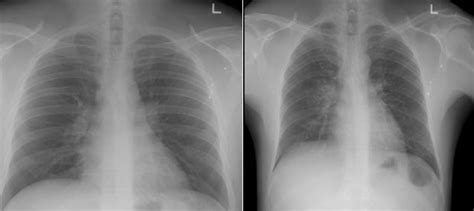 (L) Normal Chest X-Ray (R) Abnormal Chest X-Ray