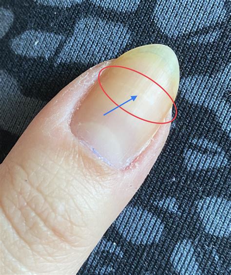 For those asking if your nail beds will grow/reattach... More in the comments section : r/nailbiting