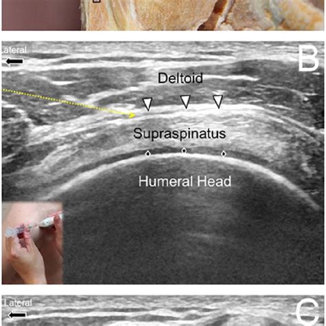 Shoulder Bursitis Injection