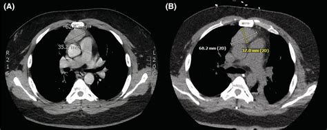 (A). Chest CT showing 6 × 3.5 cm anterior mediastinal mass consistent... | Download Scientific ...