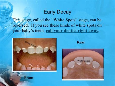 Pediatric Dentist, Bangalore: Process of Dental Caries in Children