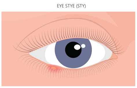 What is a Stye? | What is a Chalazion? | Treatment for Styes