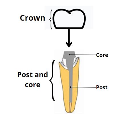 Do you need a post-crown for your tooth? Pros, Cons, Types, and More