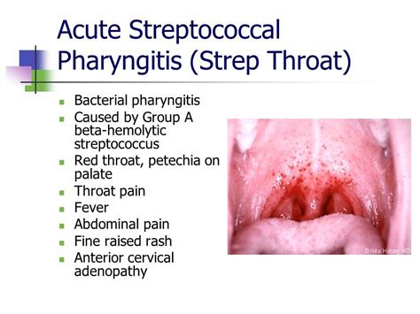 Petechiae Causes