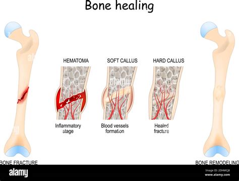 Bone healing Process after a bone fracture. Stages Of Bone Healing. Vector diagram Stock Vector ...