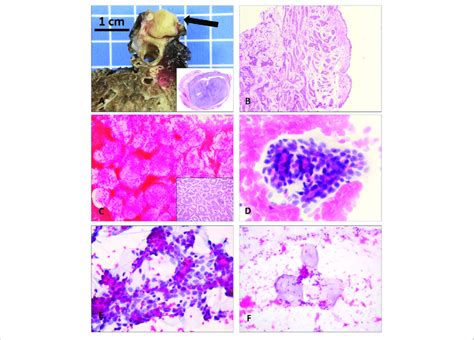 | Macroscopic, histological, and cytological aspects of primary adenoid... | Download Scientific ...