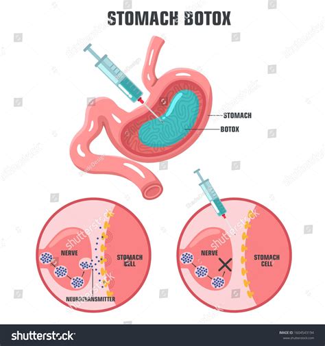 26 Stomach Botox Procedure Images, Stock Photos, 3D objects, & Vectors | Shutterstock