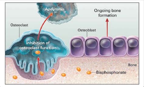 Proposed mechanism of action of bisphosphonates. Reprinted, with ...