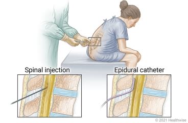 Spinal and Epidural Anesthesia | HealthLink BC