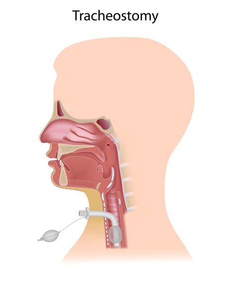 tracheostomy - Pediatric Pulmonologists