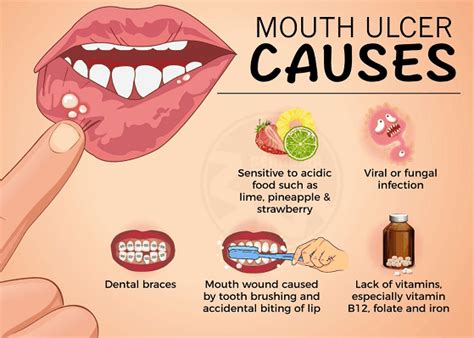 Mouth Ulcers: Types, Causes, Symptoms & Treatments